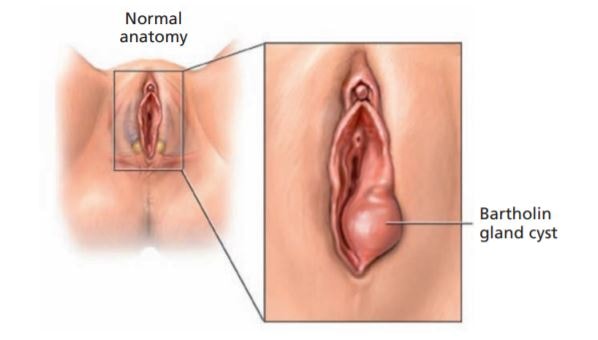 On labia lump outer Bumps On