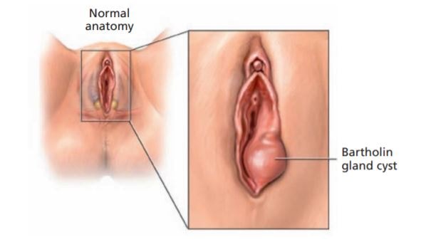 Bartholin's cyst and abscess treatment - GYNECOLOGY